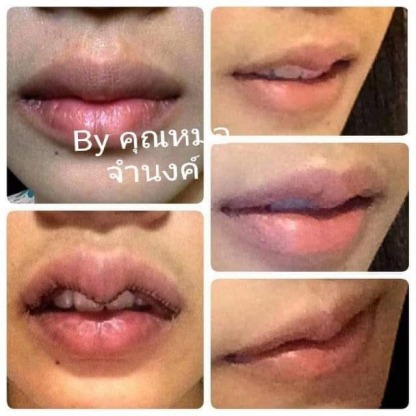 ศัลยกรรมทำปากบาง รังสิต - คลินิกศัลยกรรมตกแต่งเสริมสวย รังสิต