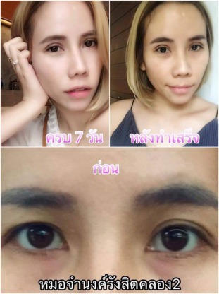 เสริมจมูกรูปหยดน้ำ - คลินิกศัลยกรรมตกแต่งเสริมสวย รังสิต