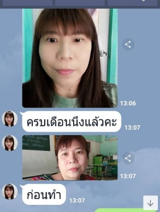 ปรับแก้โครงหน้าเบี้ยว - คลินิกศัลยกรรมตกแต่งเสริมสวย รังสิต