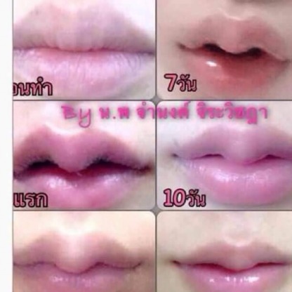 ทำปากกระจับ - คลินิกศัลยกรรมตกแต่งเสริมสวย รังสิต