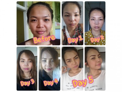 ทำจมูกเกาหลี-เจ็บตัวน้อย - คลินิกศัลยกรรมตกแต่งเสริมสวย รังสิต