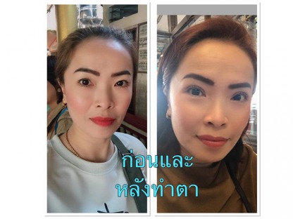 ทำตา-2-ชั้น-สำหรับคนอายุ-40 - คลินิกศัลยกรรมตกแต่งเสริมสวย รังสิต