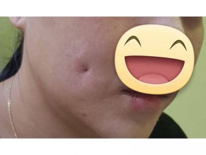 ทำลักยิ้มสวยๆ - คลินิกศัลยกรรมตกแต่งเสริมสวย รังสิต