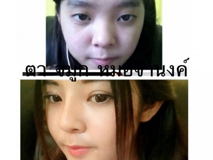 ทำหน้า-ตา-จมูก-เกาหลี - คลินิกศัลยกรรมตกแต่งเสริมสวย รังสิต