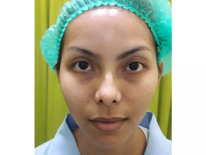 โบท็อกหน้าเรียวสวย - คลินิกศัลยกรรมตกแต่งเสริมสวย รังสิต