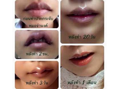 รีวิวทำปากกระจับสวยๆ - คลินิกศัลยกรรมตกแต่งเสริมสวย รังสิต
