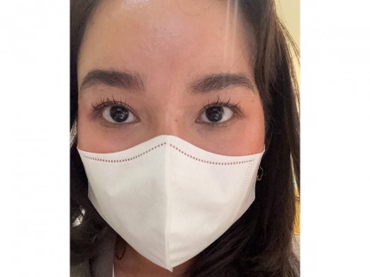 ปรับแก้ไขหนังตาให้เข้ารูป - คลินิกศัลยกรรมตกแต่งเสริมสวย รังสิต