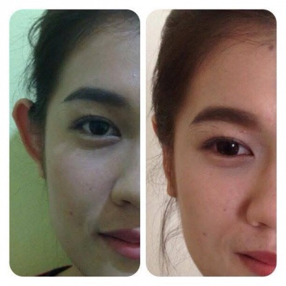 ศัลกรรมแก้ไขหูกาง - คลินิกศัลยกรรมตกแต่งเสริมสวย รังสิต