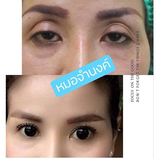 คลินิกศัลยกรรมตกแต่งเสริมสวย รังสิต - แก้ไขตาสองชั้นโดยหมอศัลกรรมเฉพาะทาง