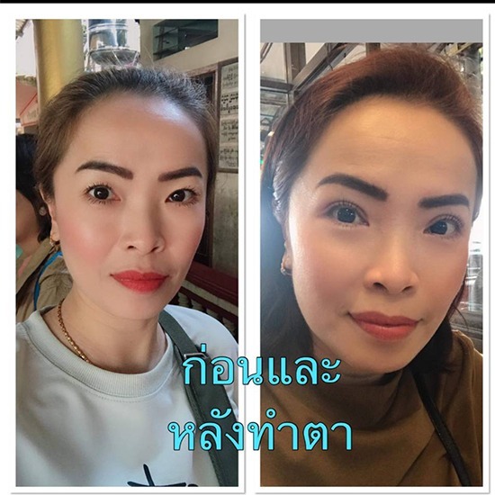 คลินิกศัลยกรรมตกแต่งเสริมสวย รังสิต - ทําตาสองชั้น ราคาเท่าไหร่