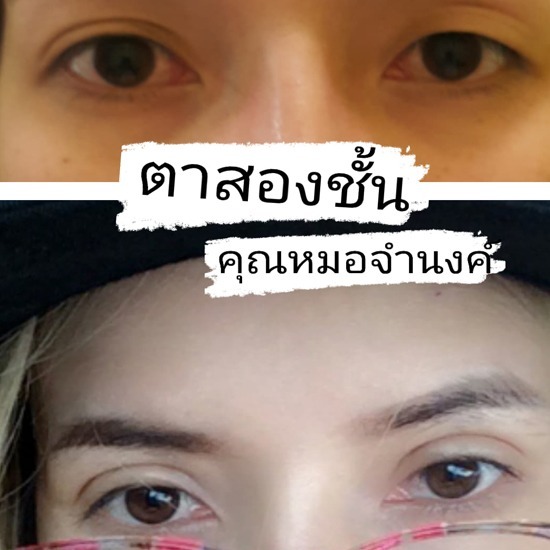 รับแก้ตาสองชั้นไม่เท่ากัน โดยหมอศัลยกรรม - คลินิกศัลยกรรมตกแต่งเสริมสวย รังสิต