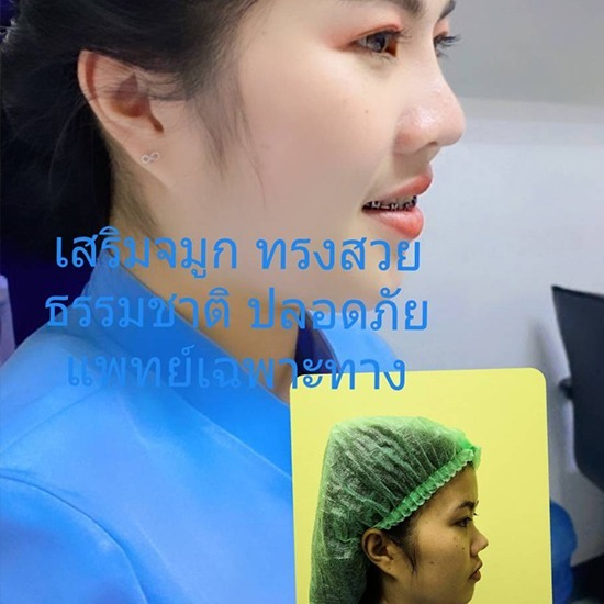 คลินิกศัลยกรรมตกแต่งเสริมสวย รังสิต - เสริมจมูกแบบโอเพ่น ทรงสวย ปลอดภัยโดยแพทย์เฉพาะทาง