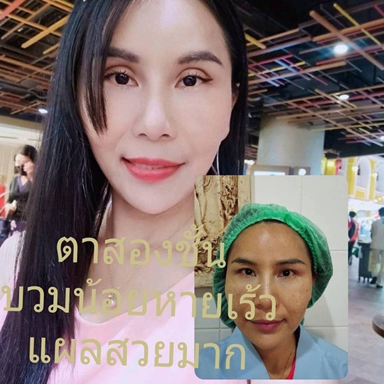 คลินิกศัลยกรรมตกแต่งเสริมสวย รังสิต - แก้ปัญหาตาสองชั้นหลบใน โดยหมอจำนงค์