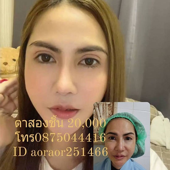 คลินิกศัลยกรรมตกแต่งเสริมสวย รังสิต - คลินิกทำตาสองชั้น แก้ตาสองชั้น ราคาพิเศษ