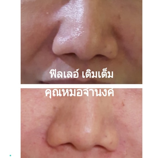 ฉีดฟิลเลอร์โดยแพทย์ศัลยกรรม ราคาพิเศษ - คลินิกศัลยกรรมตกแต่งเสริมสวย รังสิต