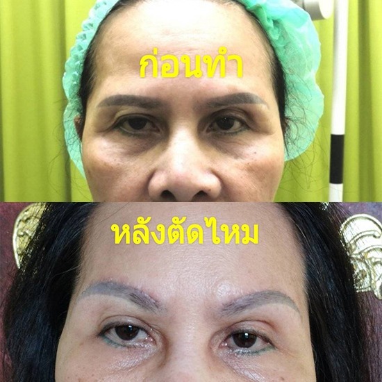 คลินิกศัลยกรรมตกแต่งเสริมสวย รังสิต - ยกคิ้ว ดึงคิ้ว แก้ไขหนังตาตก หมอจำนงค์
