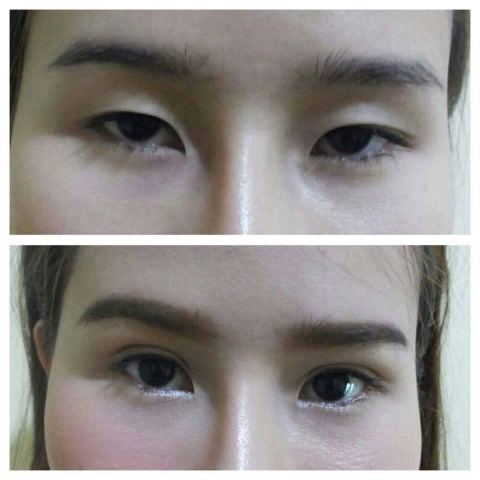 แก้ไขตาสองชั้น