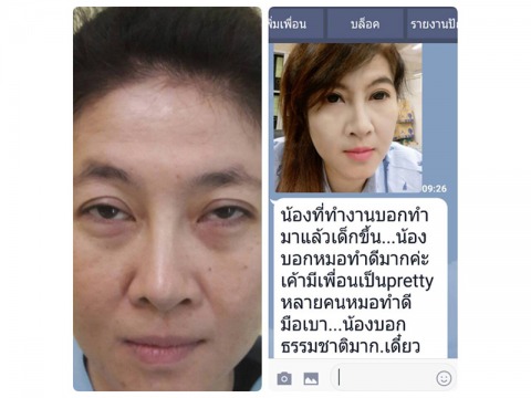 แก้ไขกล้ามเนื้อตาตก-ตาหย่อน