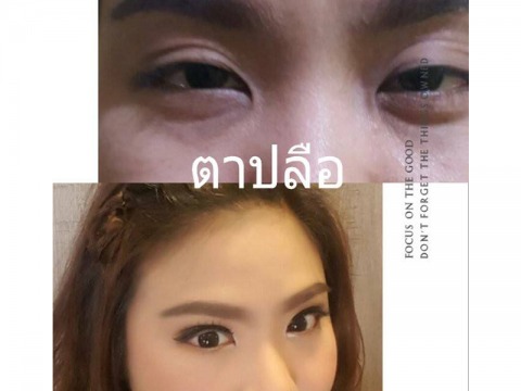แก้ไขตาปรือ-ยกกระชับตา