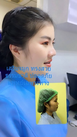 รีวิวเสริมจมูกหมอจำนงค์